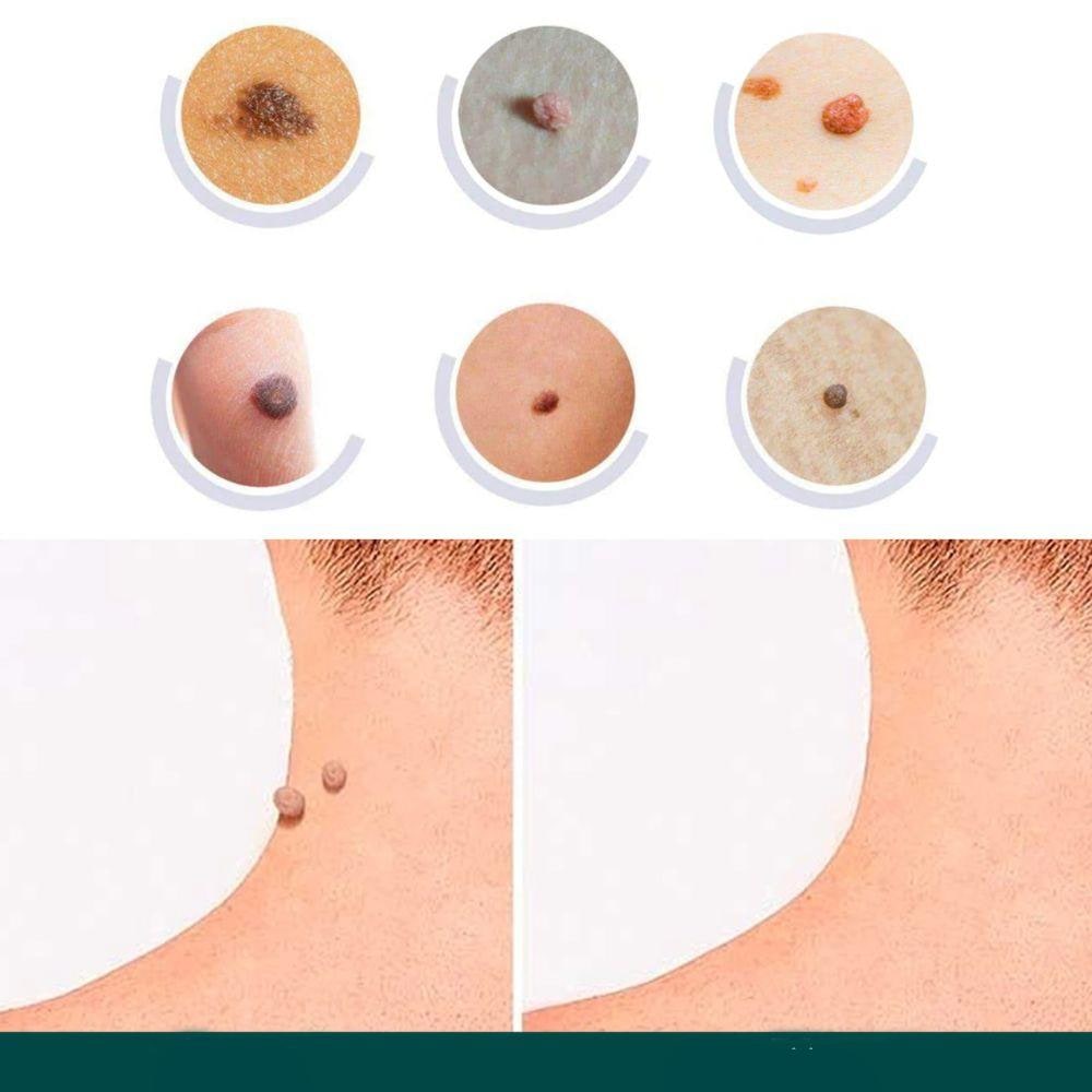 Hydrocolloid Skin Tag Patches