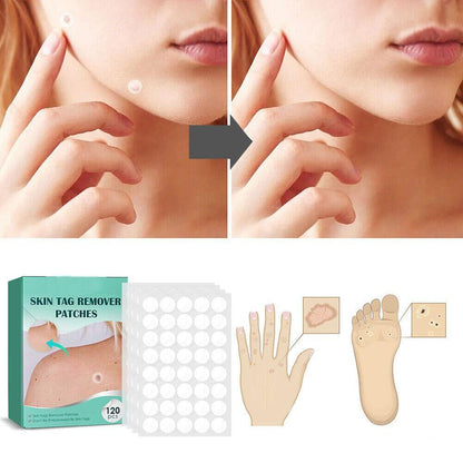 Hydrocolloid Skin Tag Patches